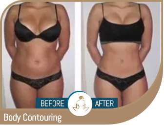 Body Contouring - True Essence Skin & Laser Med Spa Surre, BC